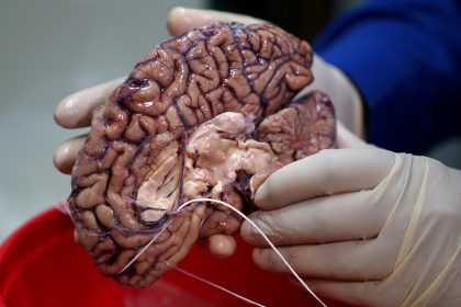 Modeyso Neues Mittel zur Behandlung von aggressivem Gehirnkrebs