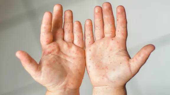 Meningitis erkennen: Symptome und Risiken im Überblick. Aktuelle Lage und wichtige Hinweise 