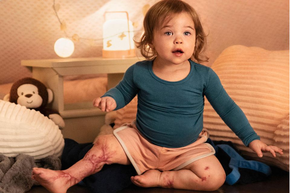 Meningitis erkennen: Symptome und Risiken im Überblick. Aktuelle Lage und wichtige Hinweise 